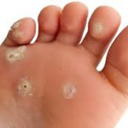 درمان پاي‌ ديابتي‌ و مشكلات‌ پوستي‌