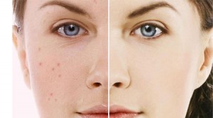 هومیوپاتی و آکنه(جوش)