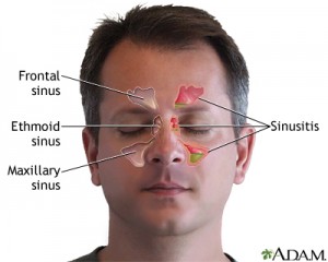 sinusitis