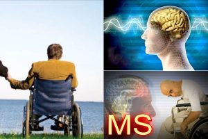 اختلال در راه رفتن در بیماری ام اس