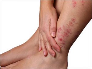 پسوریازیس چیست و چگونه درمان میشود