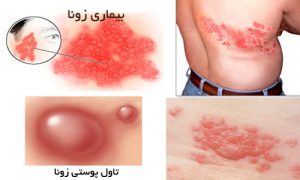 بیماری زونا و درمان آن