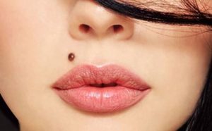 لنتيگو و خال های سطحی