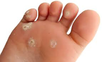 درمان پاي‌ ديابتي‌ و مشكلات‌ پوستي‌