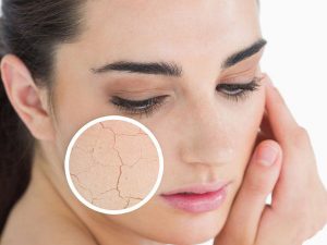 خارش‌ زمستاني‌ (اگزماي‌ خشك‌)