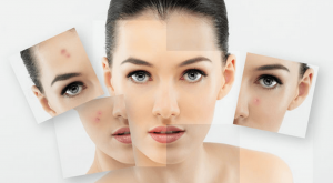 درمان جوش های بزرگسالی (آکنه‌ روزاسه‌) به روش هومیوپاتی