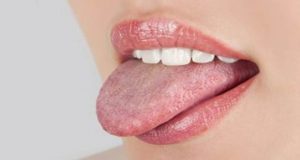 درمان برفك‌ دهان به کمک هومیوپاتی