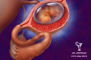 حاملگي‌ خارج‌ رحمي‌