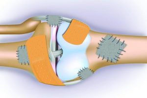 جلوگیری از پوکی استخوان به کمک نمک دریا