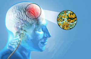 پیشگیری و درمان مننژیت