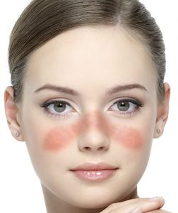 آیا درمانی برای بیماری لوپوس وجود دارد؟