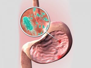 نقش تغذیه مناسب در بهبود زخم معده