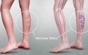 درمان واریس