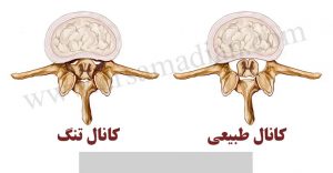 بهترین روش درمان تنگی کانال نخاعی