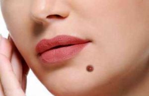 انواع خال و خوش خیم یابدخیم بودن آنها