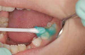 فلورایدتراپی، مفید یا مضر ؟