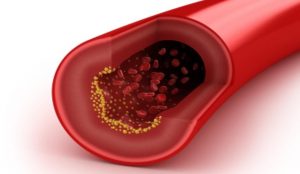 افزايش چربى خون و خطرات آن‏