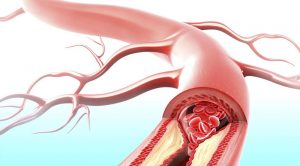 نکاتی برای درمان آترواسكلروز
