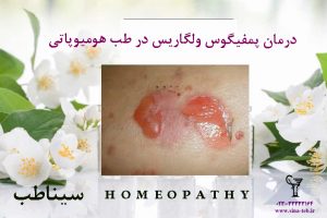 درمان پمفيگوس ولگاريس در طب هومیوپاتی