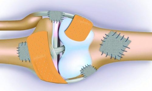 جلوگیری از پوکی استخوان به کمک نمک دریا